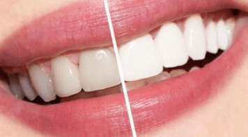 treatment2 Teeth Whitening