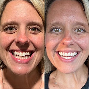 Endodontic Treatment in Yatton