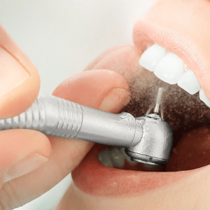 Air Polishing